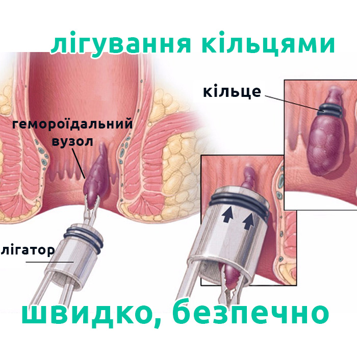 лігування латексними кільцями в м. Рівне