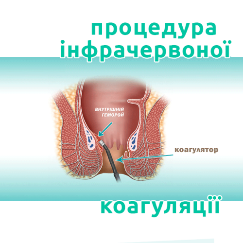 IKG_1 інфрачервона коагуляція